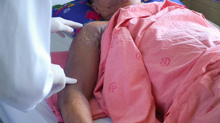 Vết thương của một nạn nhân trong vụ bị tạt axit khi đang ngồi ở bàn nhậu tại quận 7 - Ảnh: Bệnh viện cung cấp