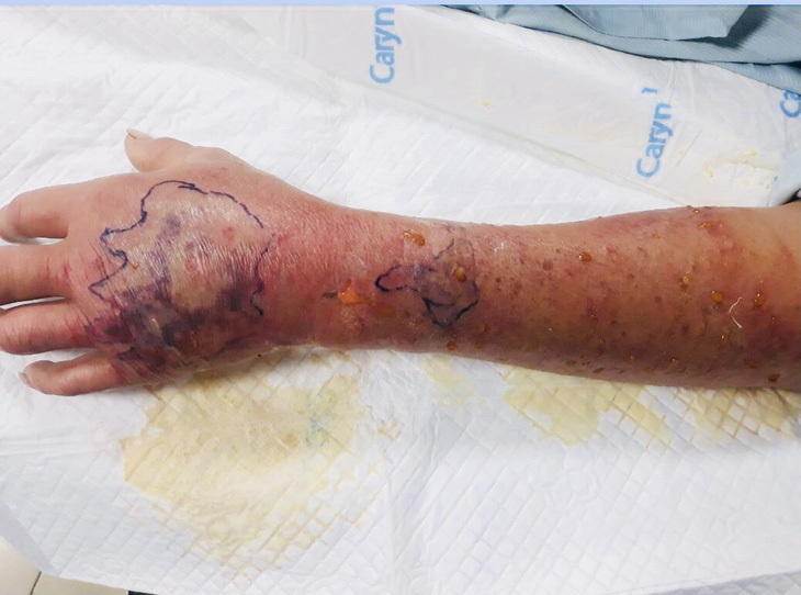 Cẳng tay của nam bệnh nhân phù nề do bị cháu 3 tuổi cắn - Ảnh: Bệnh viện cung cấp