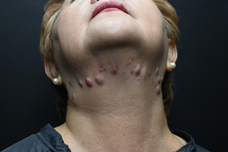 Một người phụ nữ gặp tai biến sau khi tiêm tan mỡ để cải thiện cằm đôi - Ảnh: Bệnh viện cung cấp