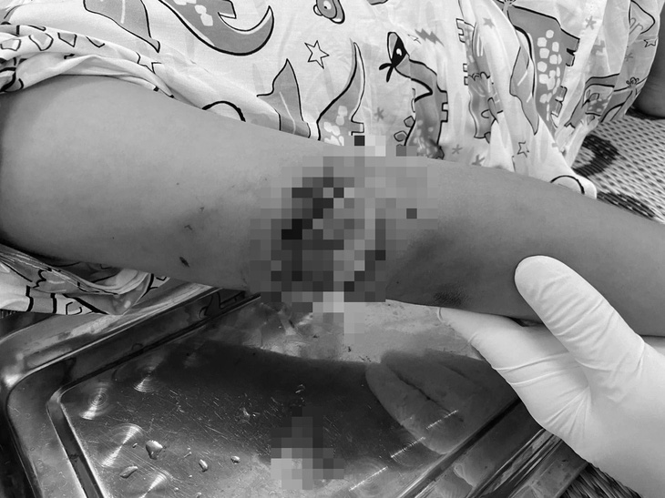Vết thương thấu xương cánh tay của bé gái bị chó cắn ở Huế - Ảnh: HỒNG NHẠN