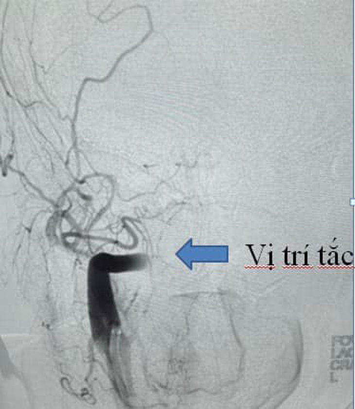 Rung nhĩ gây tắc động mạch ở bệnh nhân - Ảnh: Bệnh viện cung cấp