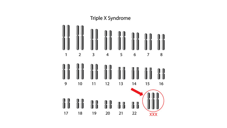 Phụ nữ mắc hội chứng siêu nữ có 3 nhiễm sắc thể X thay vì 2 - Ảnh: STORY MD