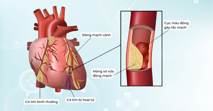 Đối tượng nào có nguy cơ hẹp động mạch vành và dấu hiệu nhận biết bệnh- Ảnh 1.