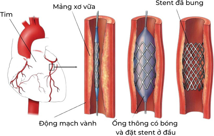 Đặt stent cho bệnh nhân bị tắc hẹp mạch vành