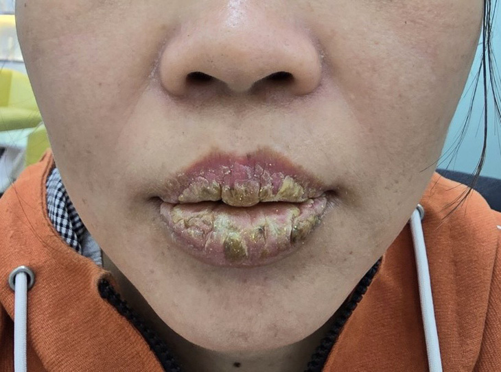 Một phụ nữ bị tai biến khi xăm môi - Ảnh: Bệnh viện cung cấp