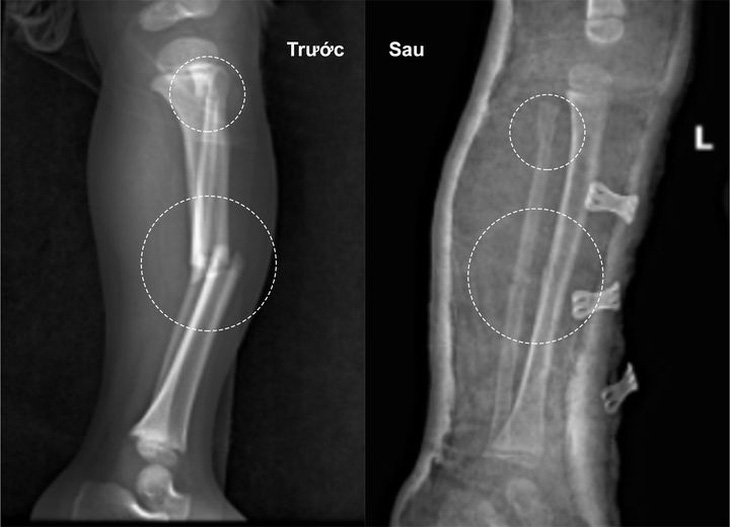 Hình ảnh xương gãy trước và sau kéo nắn, bó bột - Ảnh: BVCC