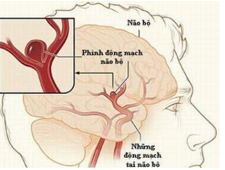 Vỡ phình mạch máu não có nguy cơ tử vong cao - Ảnh: Bệnh viện cung cấp