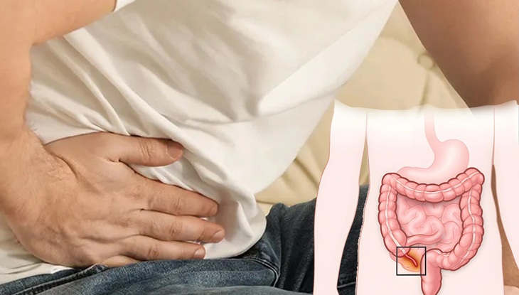 Viêm ruột thừa có thể nguy hiểm đến tính mạng nếu không được chẩn đoán kịp thời - Ảnh: Bệnh viện Hữu nghị Việt Đức