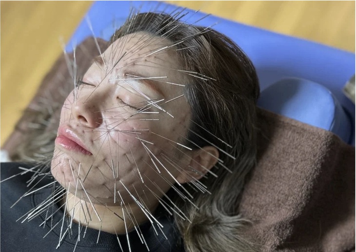 'Hóa nhím' vì phương pháp châm cứu thời thượng - Ảnh 1.