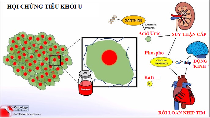 Hội chứng tiêu khối u là gì? - Ảnh 1.