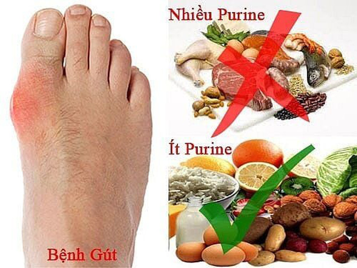 Mắc bệnh gout có cần kiêng hoàn toàn đạm? - Ảnh 1.