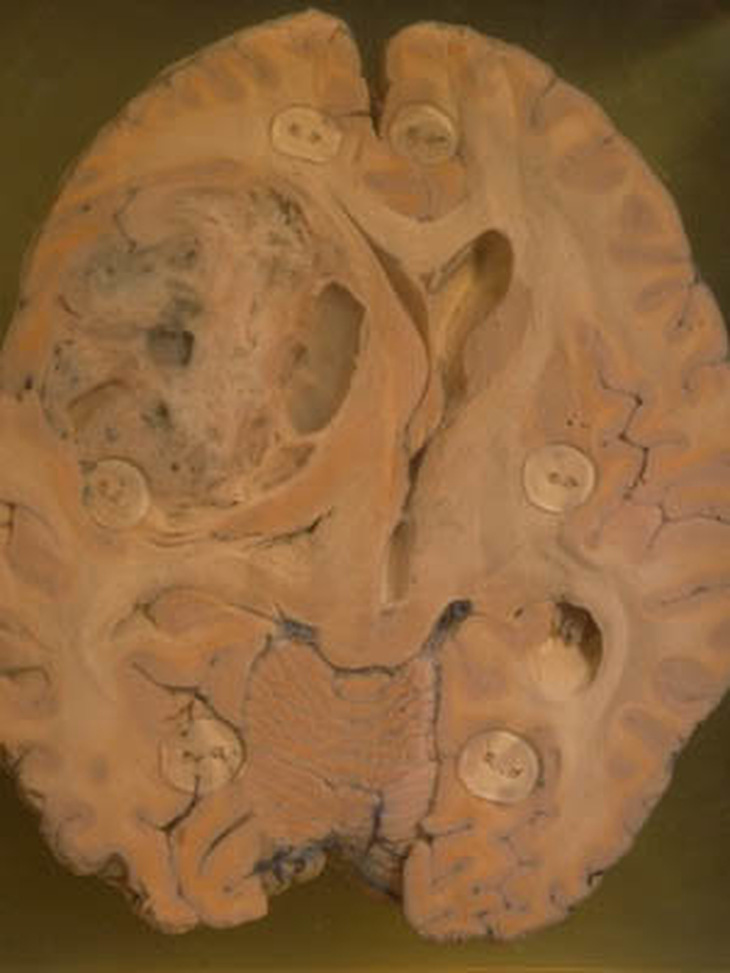 Phẫu thuật khối u não rất lớn cho bệnh nhân