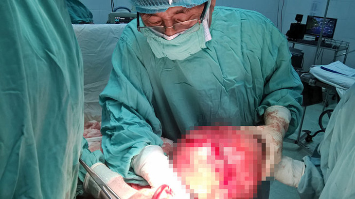 Phẫu thuật một phụ nữ u xơ tử cung hơn 5 kg