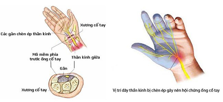 ​Hội chứng ống cổ tay – căn bệnh nhân viên văn phòng thường gặp
