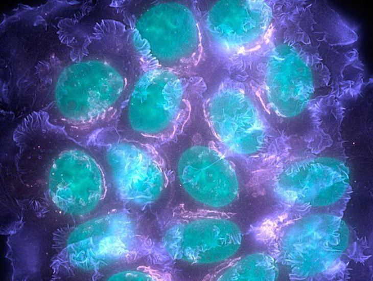 ​Xác định được các gene đột biến có khả năng gây bệnh ung thư vú
