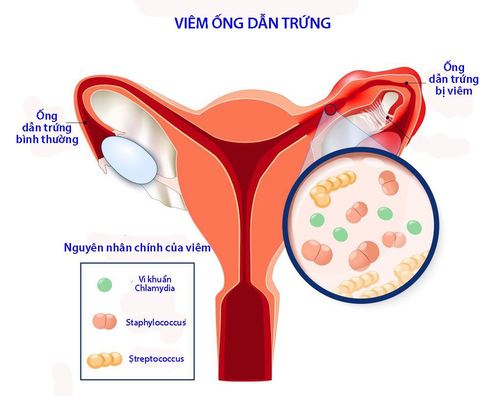 Các biến chứng thường gặp của viêm ống dẫn trứng - Ảnh 1. Các biến chứng thường gặp của viêm ống dẫn trứng - Ảnh 1.