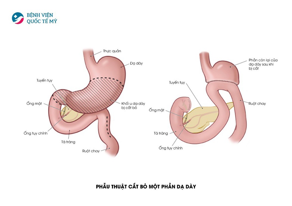 Hiểu về cơ chế điều trị ung thư thực quản, dạ dày - Ảnh 4. Hiểu về cơ chế điều trị ung thư thực quản, dạ dày - Ảnh 4.