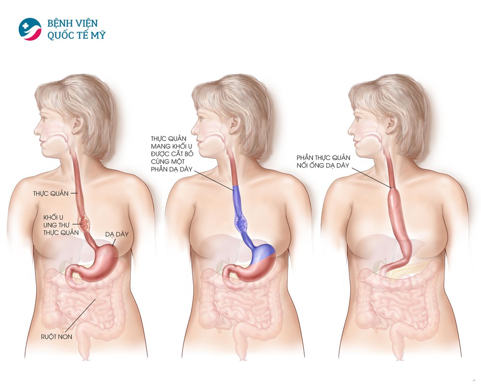 Hiểu về cơ chế điều trị ung thư thực quản, dạ dày - Ảnh 2. Hiểu về cơ chế điều trị ung thư thực quản, dạ dày - Ảnh 2.