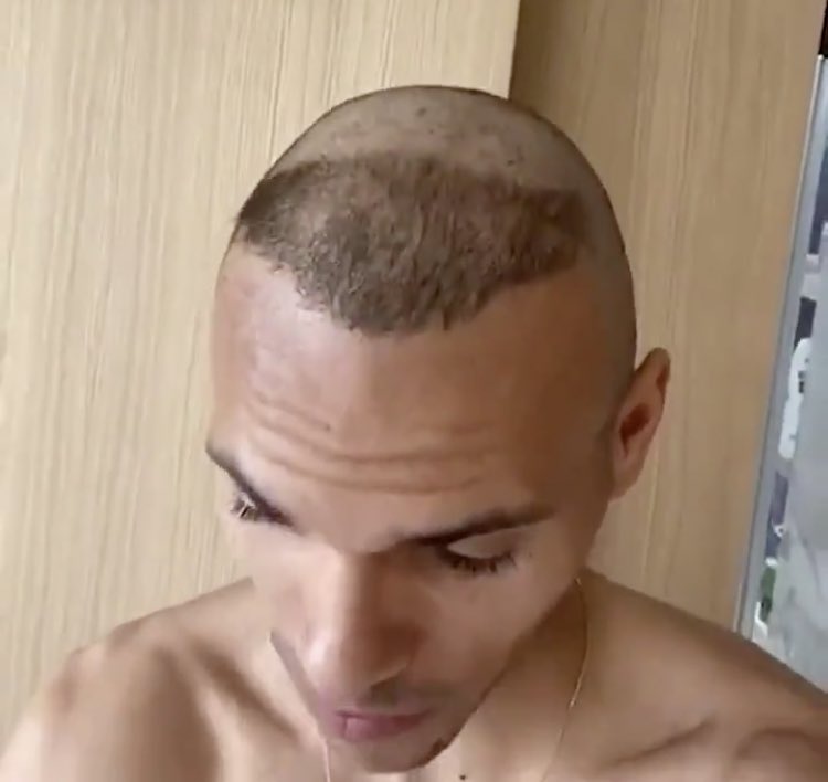 Martin Braithwaite từng hớt kiểu đầu bắt chước 