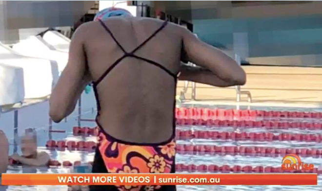Bức ảnh nam VĐV mặc bikini làm dậy sóng dư luận Australia.