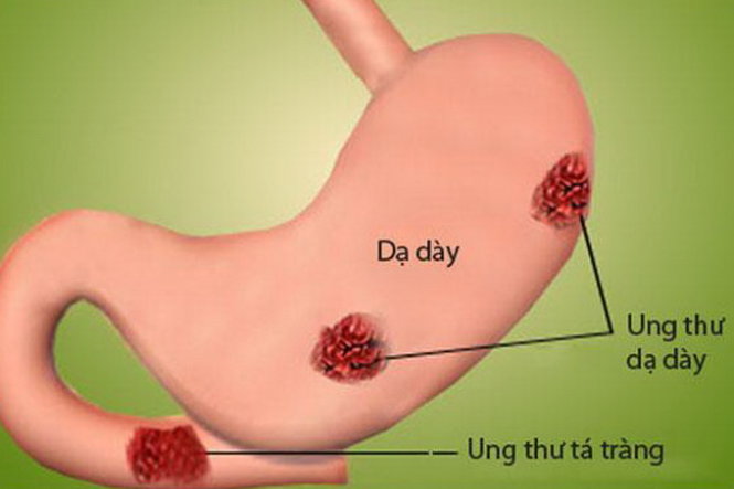 Ung thư  đường tiêu hóa đáng báo động