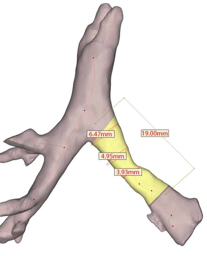 Hình ảnh quét CT được dùng để chế tạo mô hình 3D cho bệnh nhân đường hô hấp