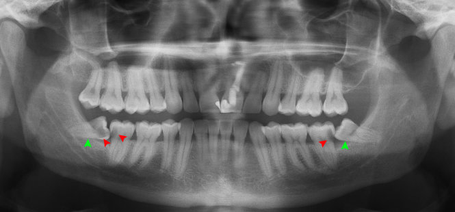 Răng khôn mọc lệch gây sâu răng và phá hủy mặt xa của răng cối lớn thứ 2