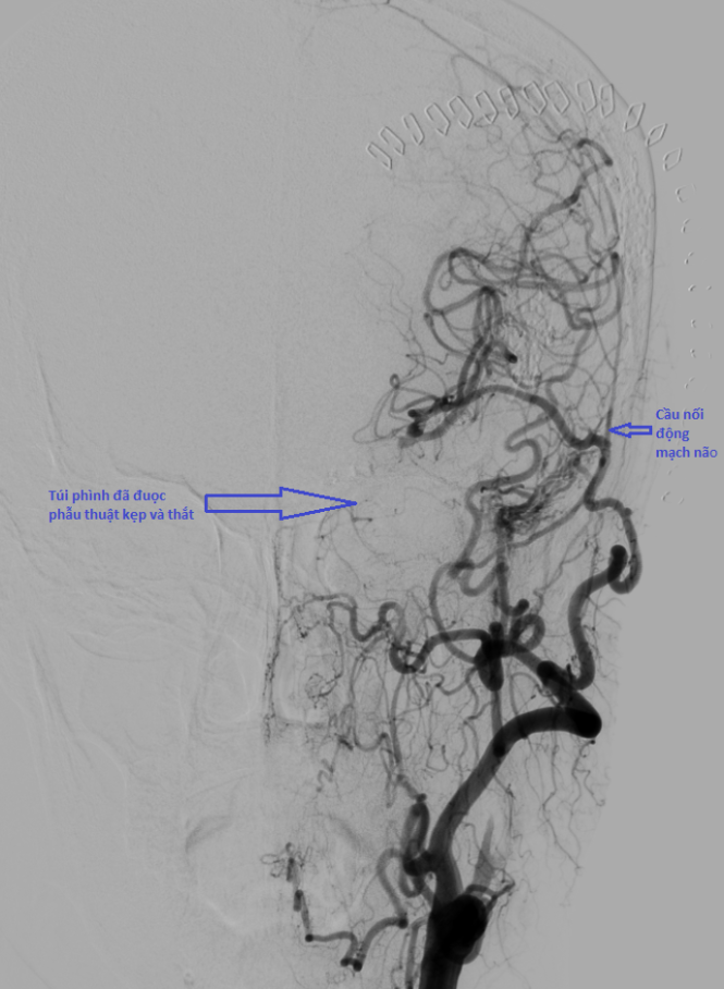 Nối một cái mạch ở ngoài vào trong, tạo một đường mới đưa máu lên trên não (giá vài chục triệu đồng), sau đó thắt cái túi kia đi. Ảnh: CTV