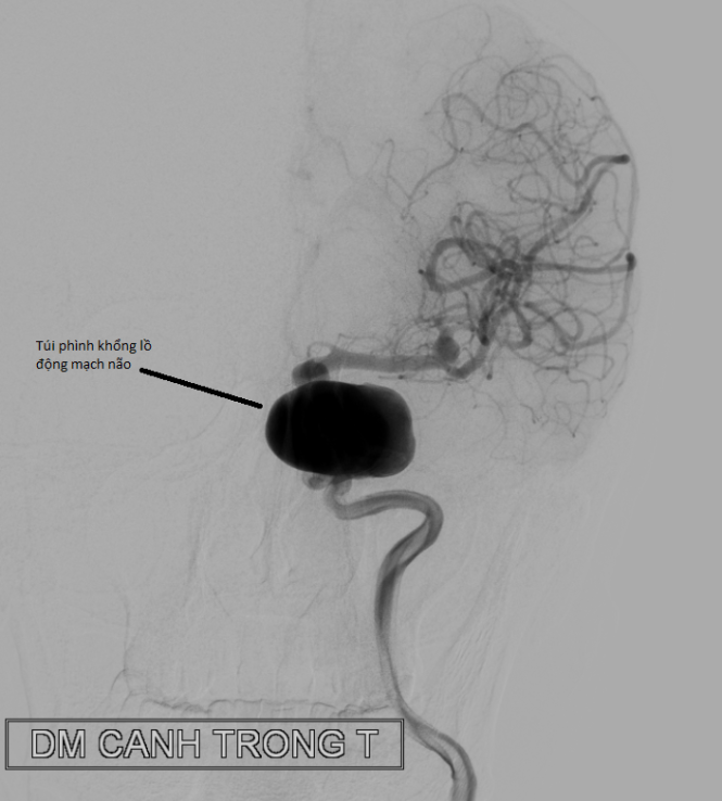 Túi phình lớn của động mạch não, để nút cái túi phình này chi phí khoảng 500 - 600 triệu đồng. Ảnh: CTV