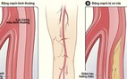 Bệnh động mạch ở chân - Những điều cần biết