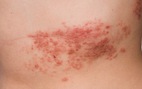 Một số bệnh da do virus thường gặp