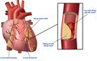 Biến chứng tim mạch của bệnh đái tháo đường