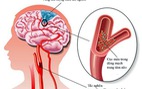 Dấu hiệu và cách xử trí cơn thiếu máu não thoáng qua
