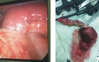 BV Tâm Trí Đồng Tháp: Phẫu thuật nội soi cắt ruột thừa do viêm túi thừa Meckel