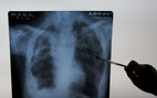 AI phát hiện COVID-19 từ ảnh X-quang phổi nhanh gấp 10 lần chuyên gia