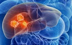 Viêm gan B, C tiến triển thành ung thư gan sau 20-30 năm, nhiều người điều trị khi đã muộn