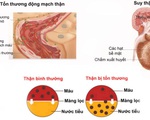 Những biến chứng nguy hiểm của bệnh sỏi thận, bạn có biết?