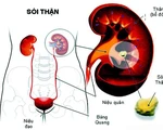 Biến chứng sỏi thận
