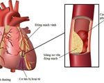 Hẹp động mạch vành có nguy hiểm?