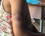 Học sinh lớp 2 bị cô đánh bầm tím vì chữ viết xấu
