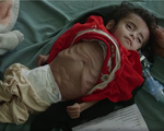 Trẻ em Yemen còn da bọc xương vì nạn đói và nội chiến kéo dài