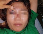 Mất thị lực do bạn trai tiêm chất làm đầy nâng mũi