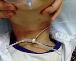 Bé 6 tuổi nhặt sợi dây nhựa nghịch tròng vào cổ suýt chết