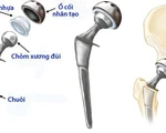 Thay khớp háng đường trước, có thể đi lại ngay hôm sau