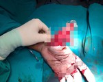 Dập nát bàn tay do đốt pháo
