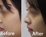 Những điều chị em nên biết khi làm đẹp bằng Filler