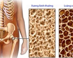 Tai biến do lạm dụng corticoid