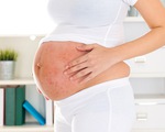 Bệnh vẩy nến có ảnh hưởng tới thai kỳ không?