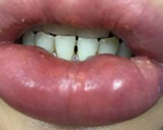 Lại một phụ nữ gặp tai biến vì bơm môi ở thẩm mỹ viện
