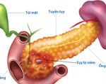 Bệnh viêm tụy cấp